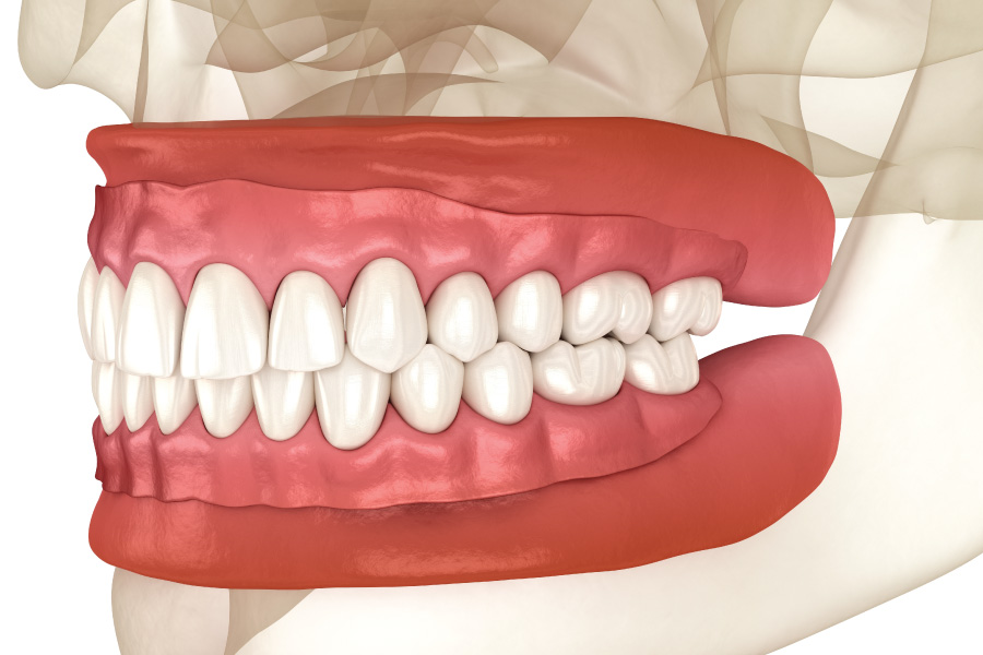 Arlington Full Dentures