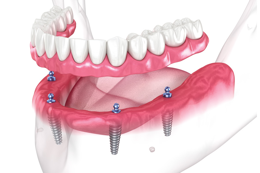 Arlington Implant-Supported Dentures